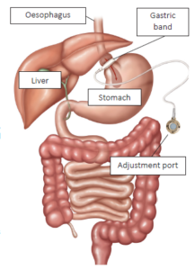 A diagram of the stomach where it shows a gastric band being tied to the top of the stomach with a small opening portal attached to the end of the band. 