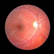 Optic Disc